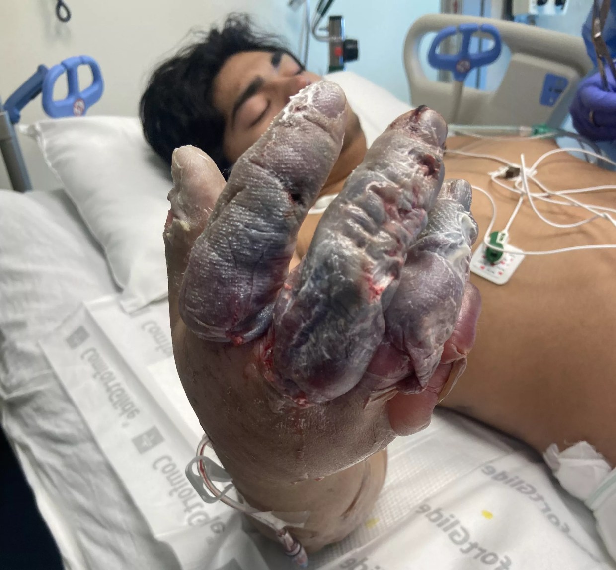 Washington Man Severely Frostbitten After Being Robbed, Left Unconscious in Snow in Denver